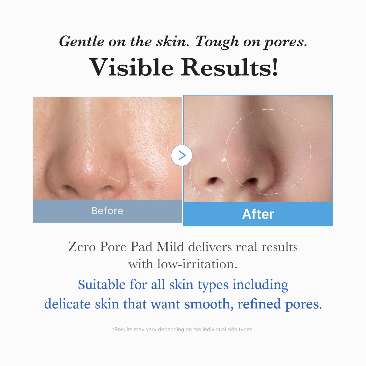 zero-pore-madecassoside-pads-mild-q6 04_6357f9f9-483b-4891-82c6-a58d336e62c8.jpg